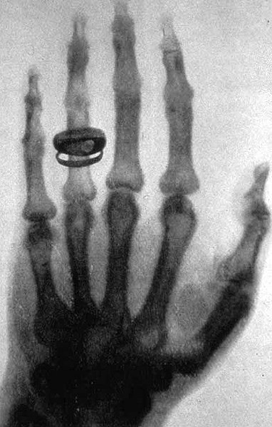 x-ray